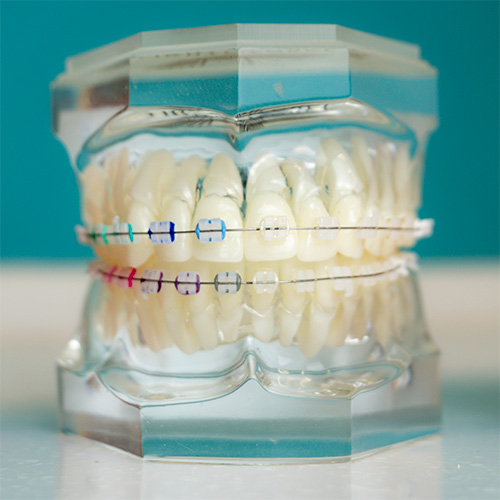 braces on a set of model teeth